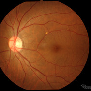 検査したときに撮影した私の左目の眼底写真。緑内障だとこの写真で神経の異常がわかる。